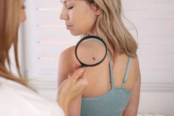 What Are Traditional Skin Lesion Removal Methods Hamilton?