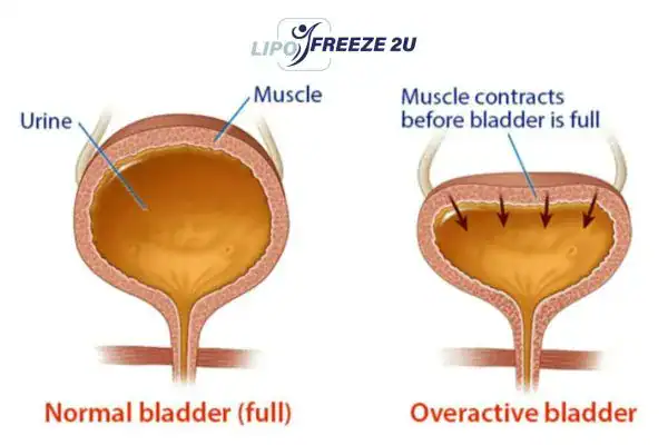 diagram of overactive bladder treatment Hamilton