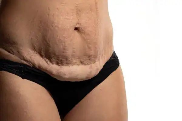 loose skin after weight loss injections Hamilton