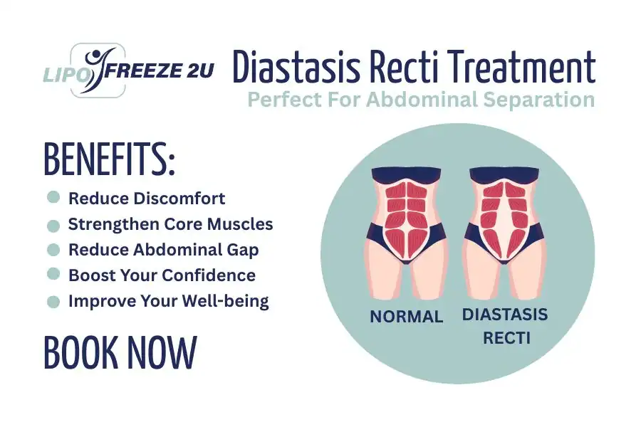 Benefits of body toning treatment Hamilton for Diastasis recti