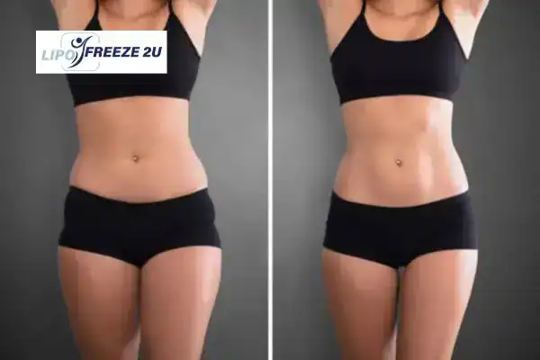 How Can LIPO FREEZE 2U Support Your Post-Pregnancy Body Recovery Hamilton?