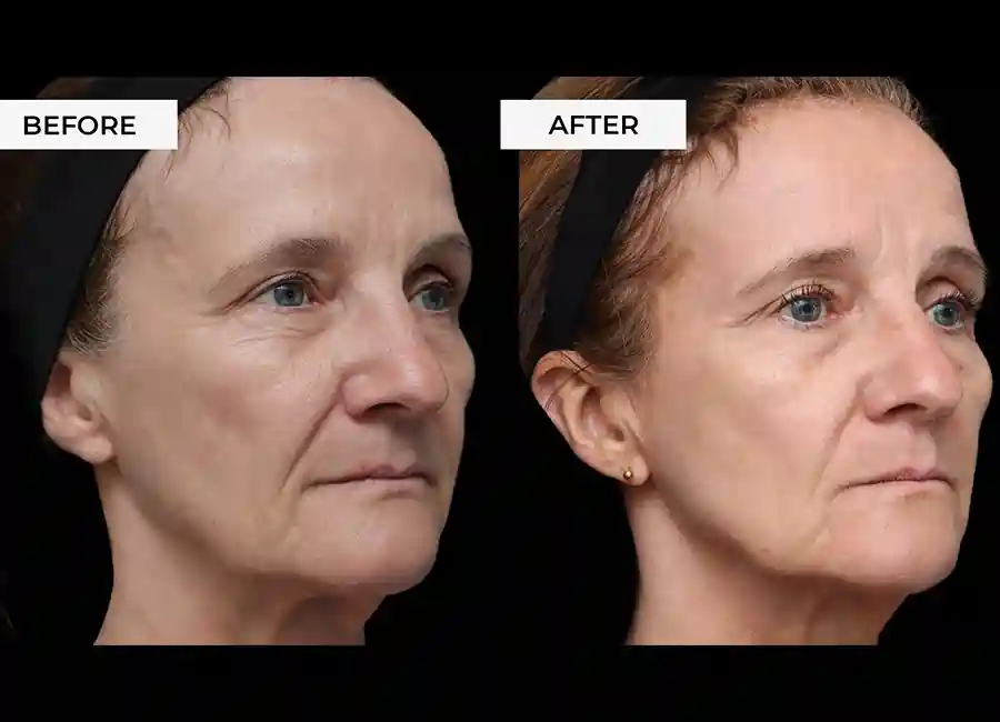How Many RF Microneedling Sessions Will You Need to See a Difference Hamilton?