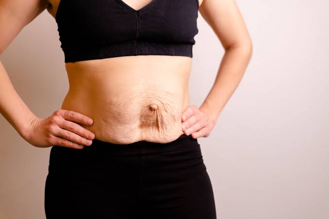 Is Surgery Really the Only Way to Repair Diastasis Recti Hamilton?