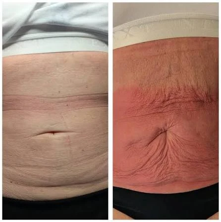 How Does RF Microneedling Improve Crepey, Thin and Uneven Skin Texture Hamilton?