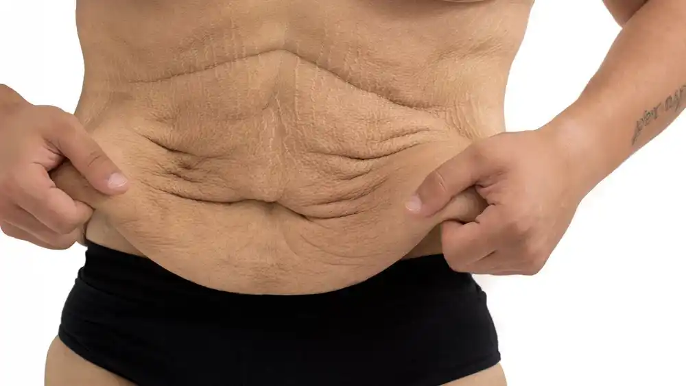 Why Does Weight Loss Medication Leave Some People With Loose or Sagging Skin Hamilton?